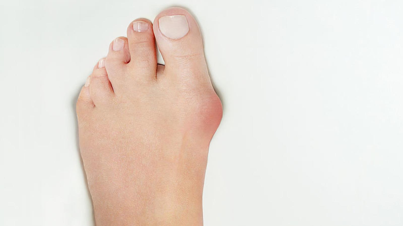 Fuß einer Frau mit Hallux Valgus