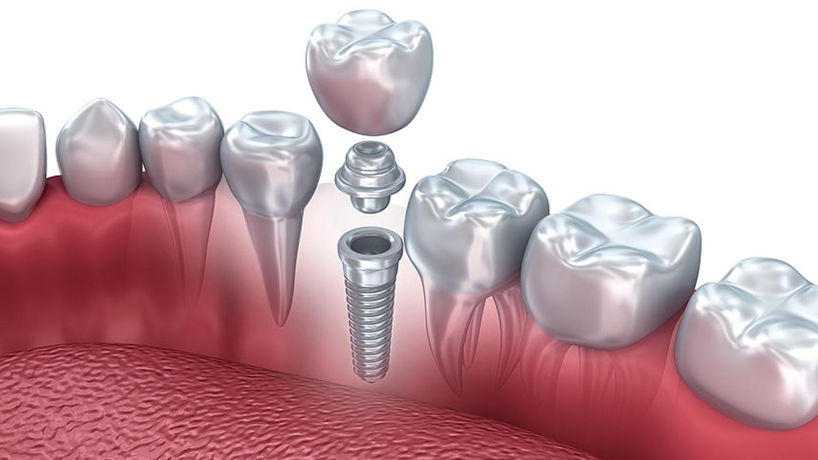 Darstellung eines Zahnimplantates