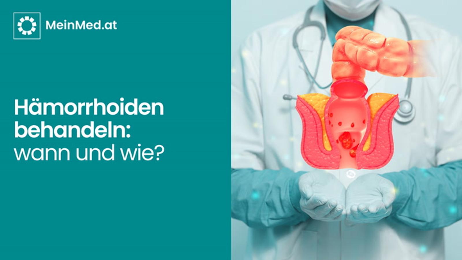 Hämorrhoiden behandeln - wann und wie?
