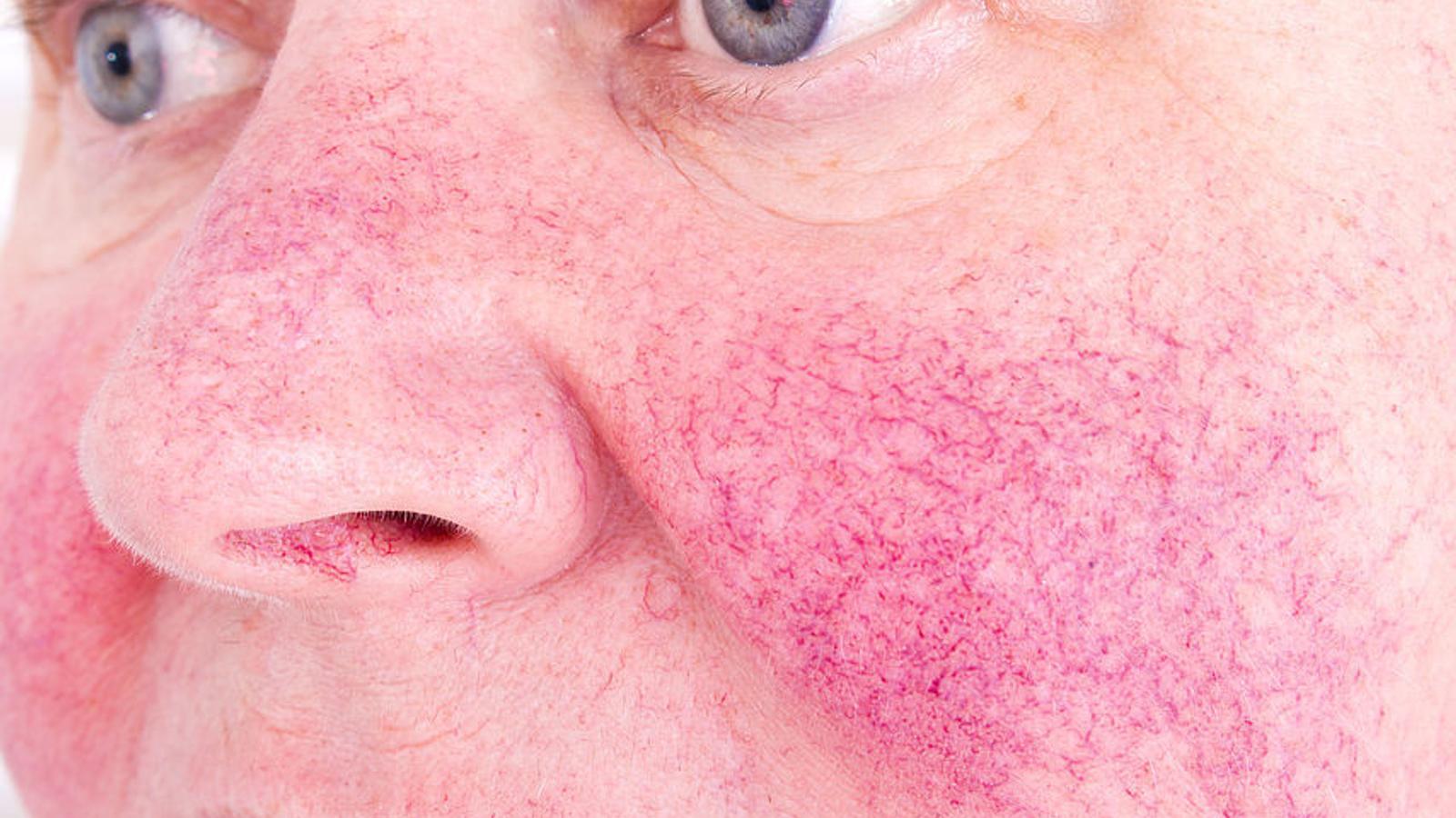 Mann mit Rosacea. 