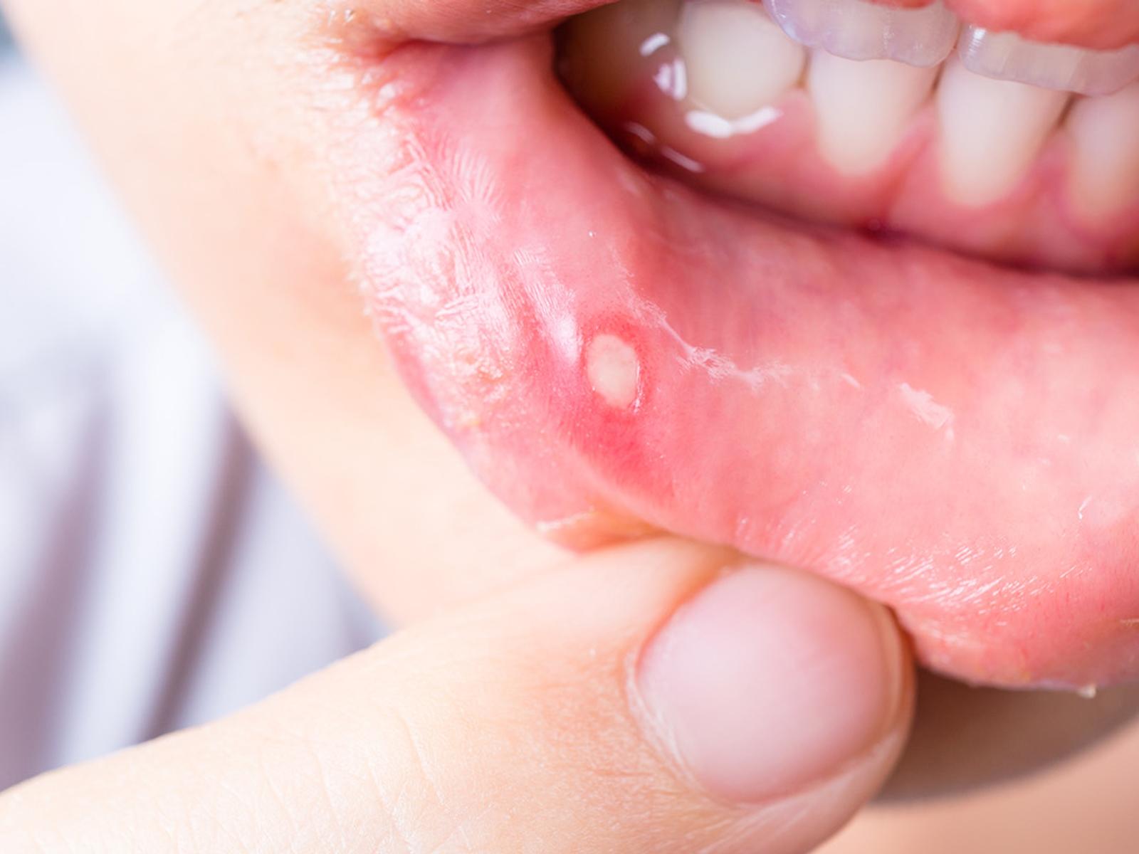 Aphten im Mund » Ansteckend? Wie behandeln?