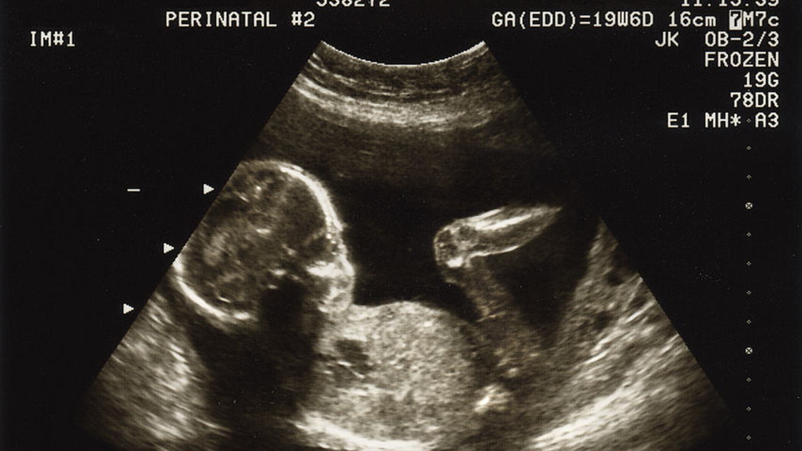 Ultraschallbild eines Babys