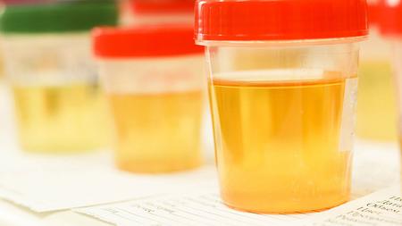 Mehrere Proben von Urin in verschiedenen Farben, die alle etwas über die Gesundheit verraten