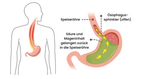 Grafik, die Magen und Speiseröhre darstellt