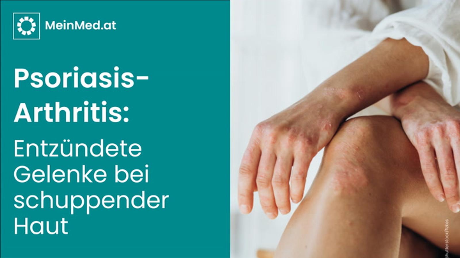 Psoriasis-Arthritis: Entzündete Gelenke bei schuppender Haut