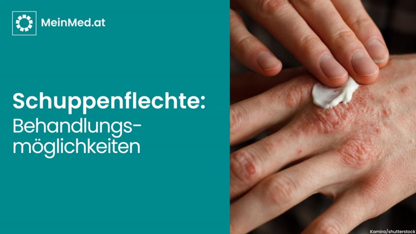 Behandlungsmöglichkeiten bei Schuppenflechte