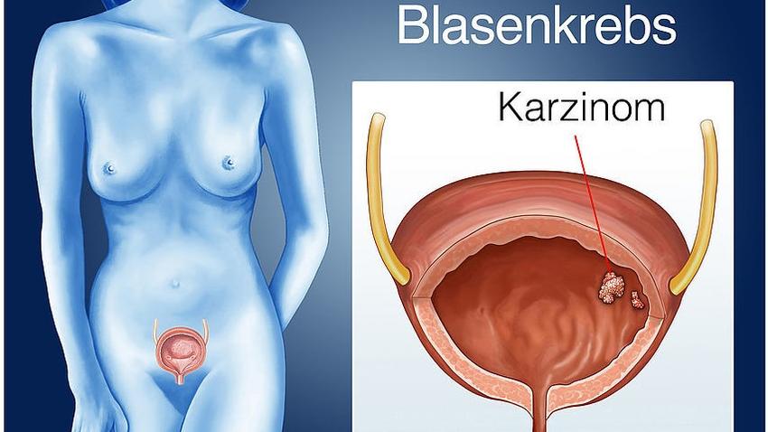 Blasenkrebs  Symptome, Ursachen und Behandlung | MeinMed.at