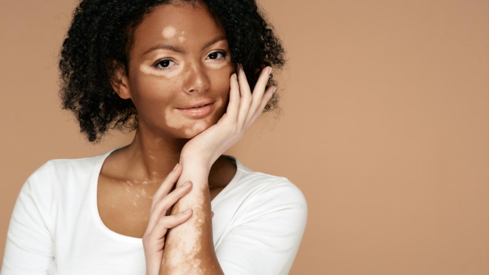 Vitiligo am Handrücken