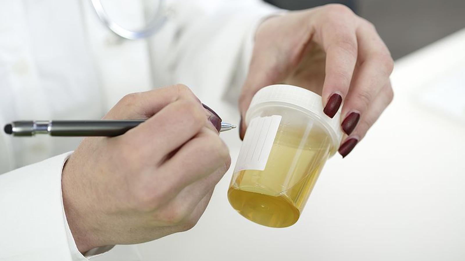 Labor-Mitarbeiterin beschriftet eine Urinprobe