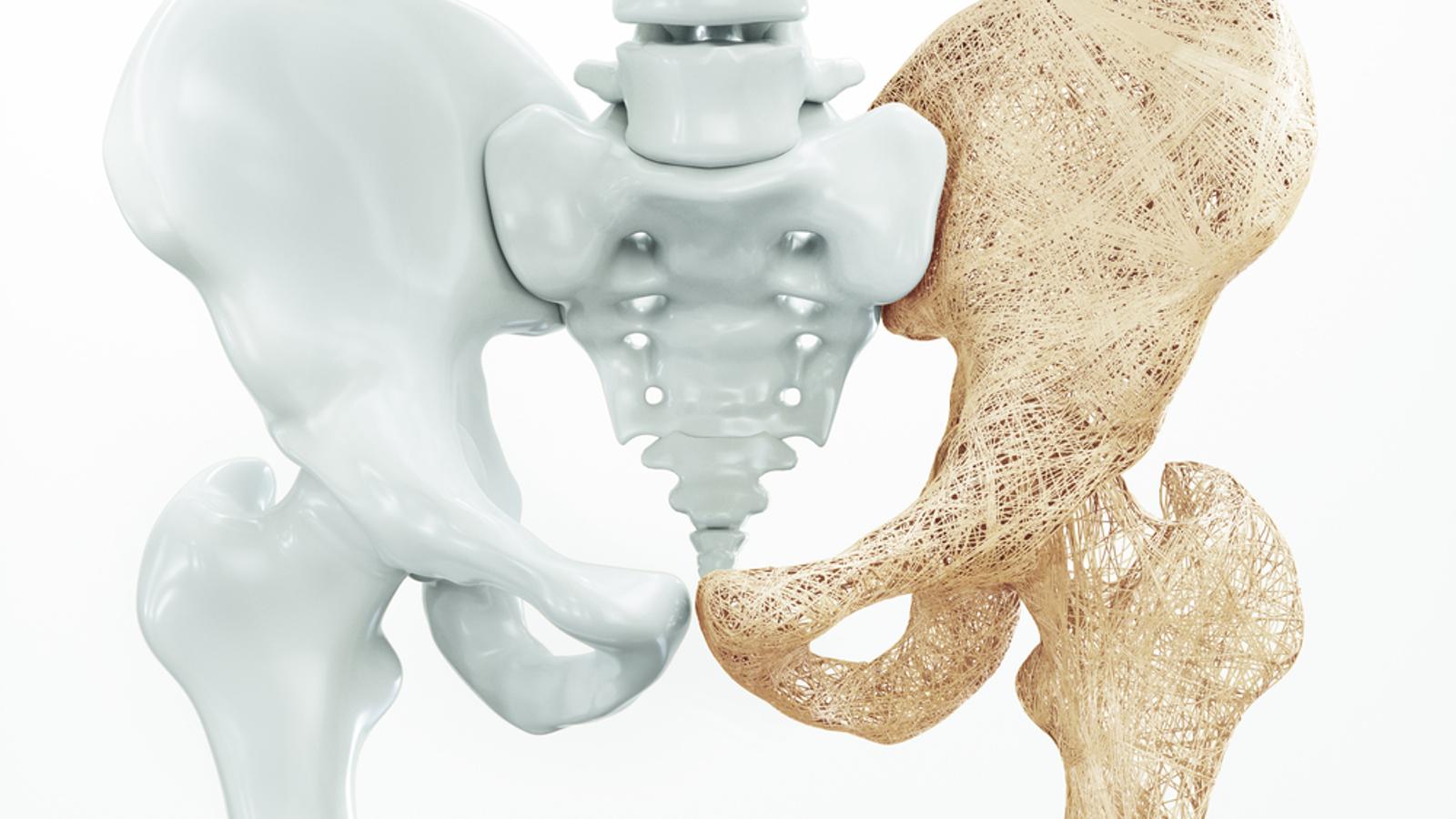Osteoporose: Eine Erkrankung mit vielen Ursachen