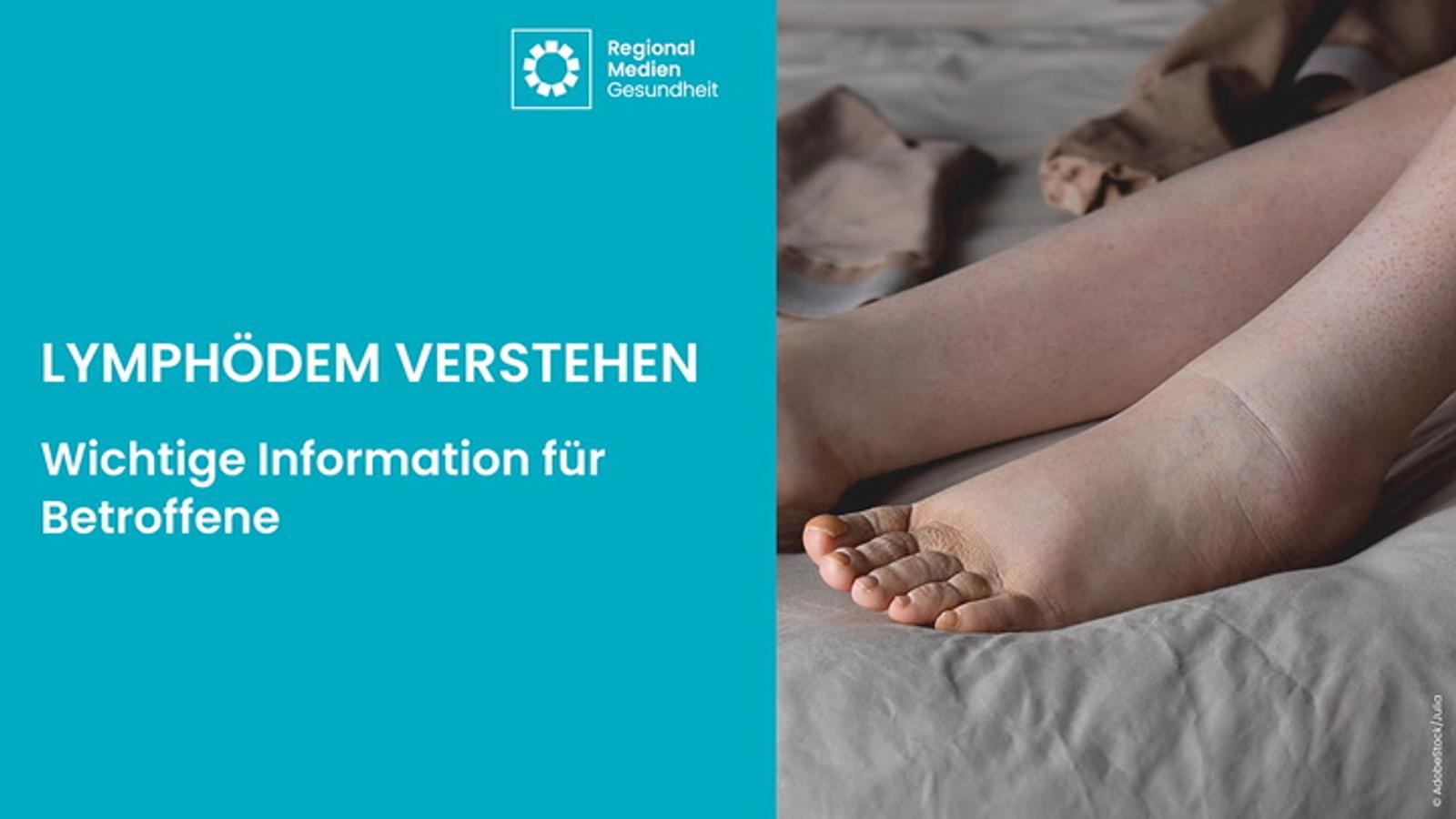Lymphödem verstehen – Wichtige Informationen für Betroffene