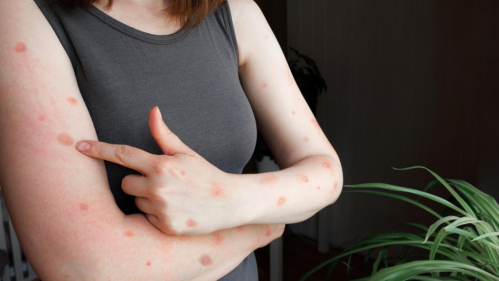 Arme einer Frau mit Monkeypox Hautausschlag