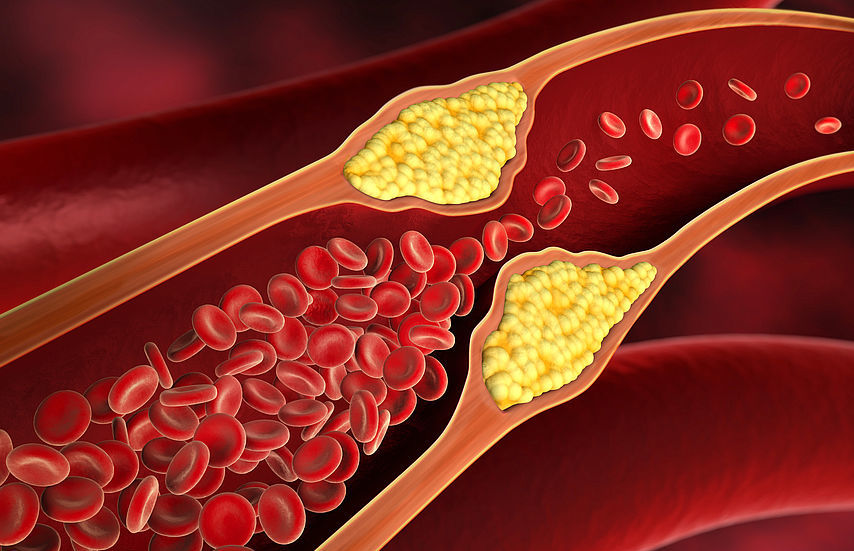 Arteriosklerose » Häufigkeit, Ursachen, Symptome & Behandlung | MeinMed.at