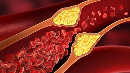 Kalk-, Bindegewebs- und Fettablagerungen verengen die Arterien. 