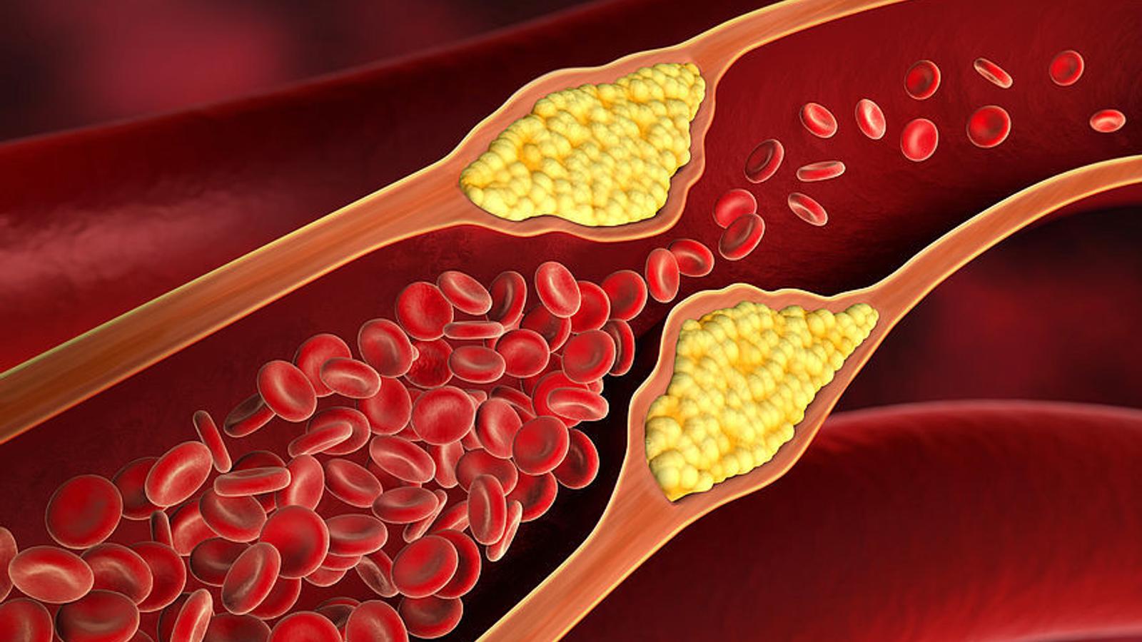 Kalk-, Bindegewebs- und Fettablagerungen verengen die Arterien. 