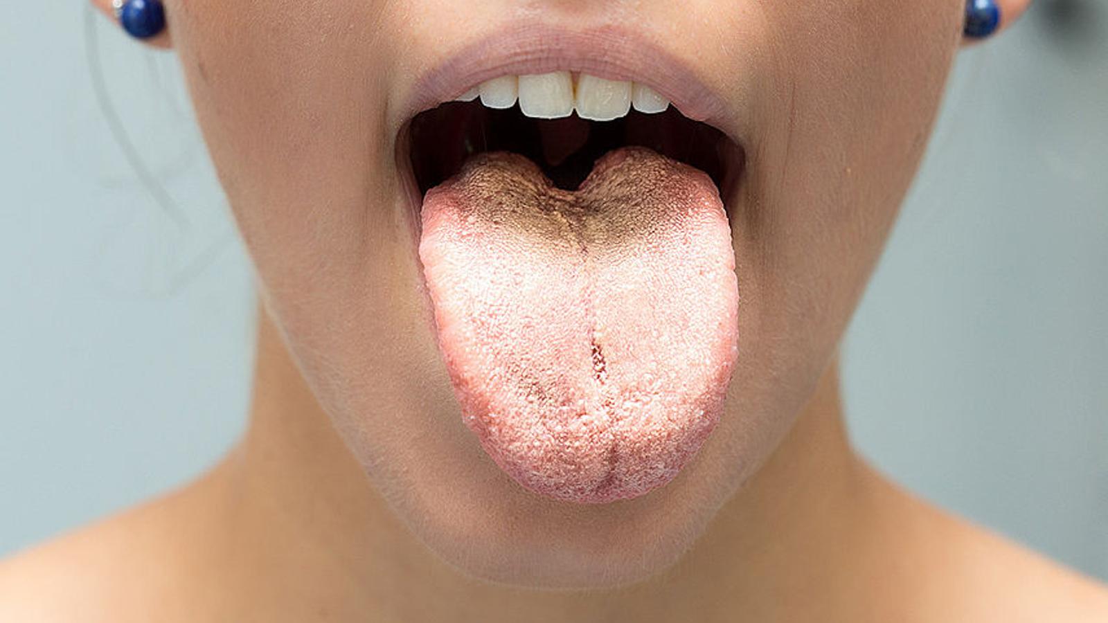 Mädchen mit Mundsoor zeigt ihre Zunge