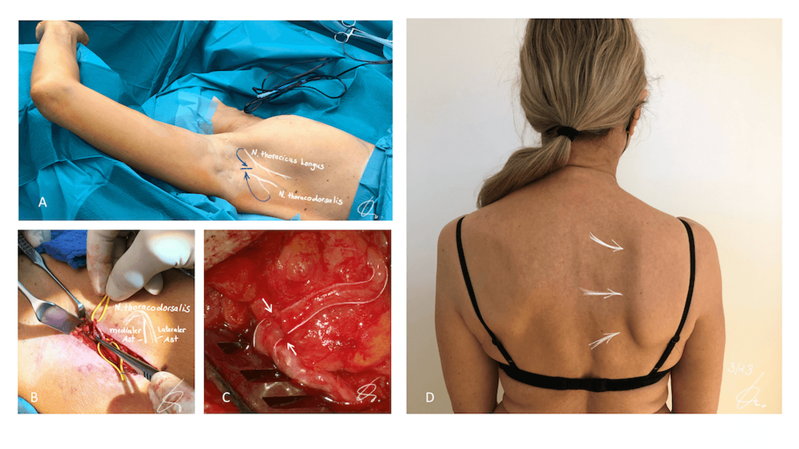 Traumatische Nervenläsionen State of the Art – Standards und Fortschritte