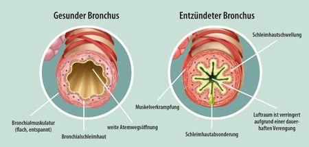 Artikelbild zu Artikel: Asthma