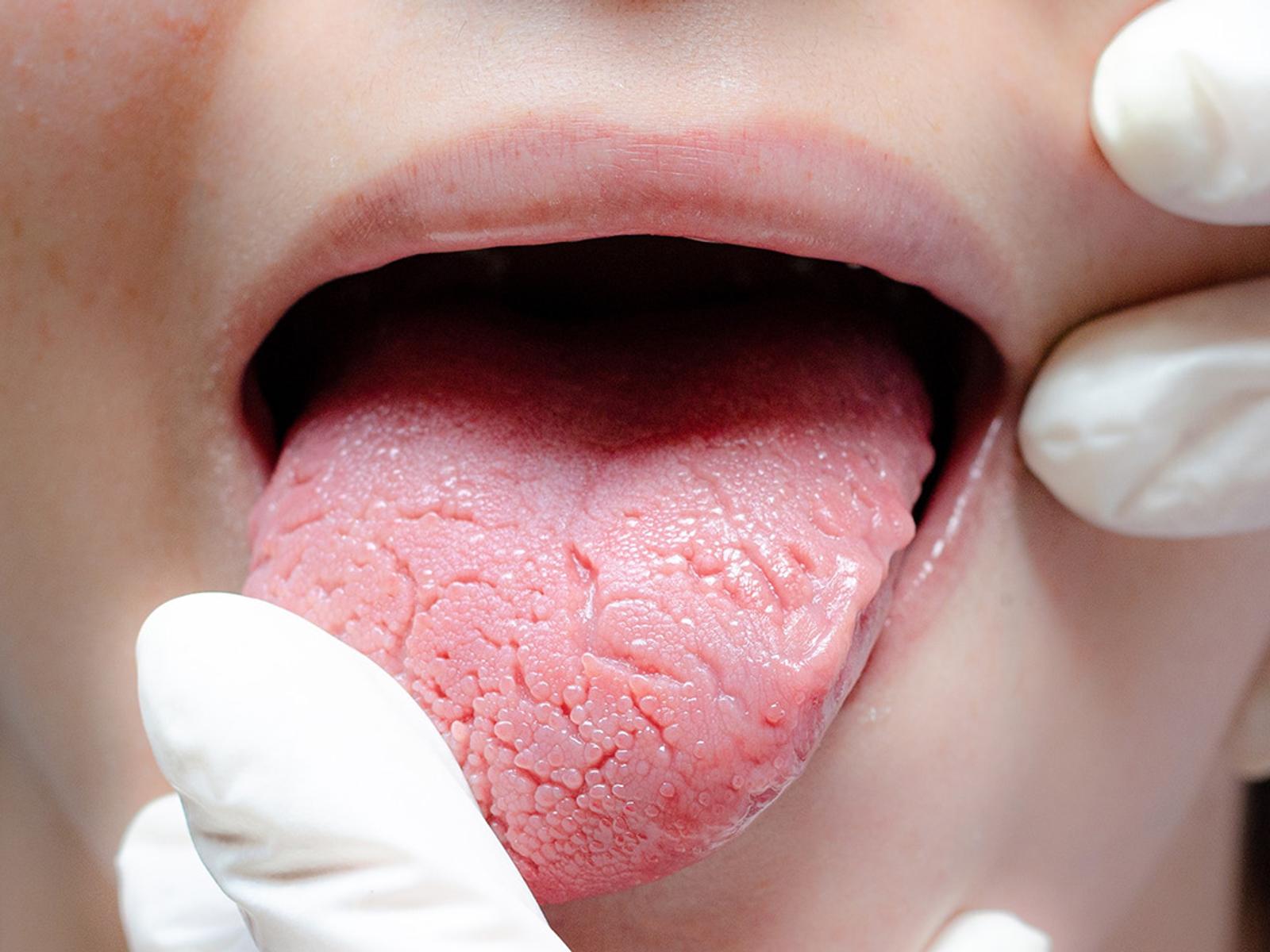 Burning Mouth Syndrome (BMS) » Ursachen & Behandlung