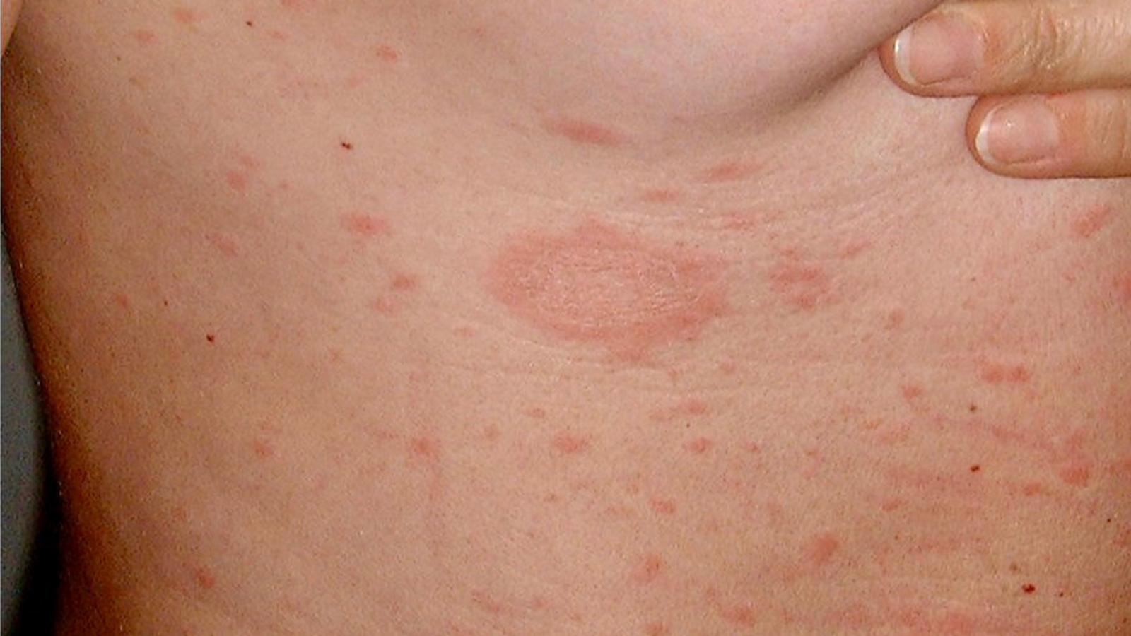 Rosa- oder hautfarbene Flecken auf dem Bauch
