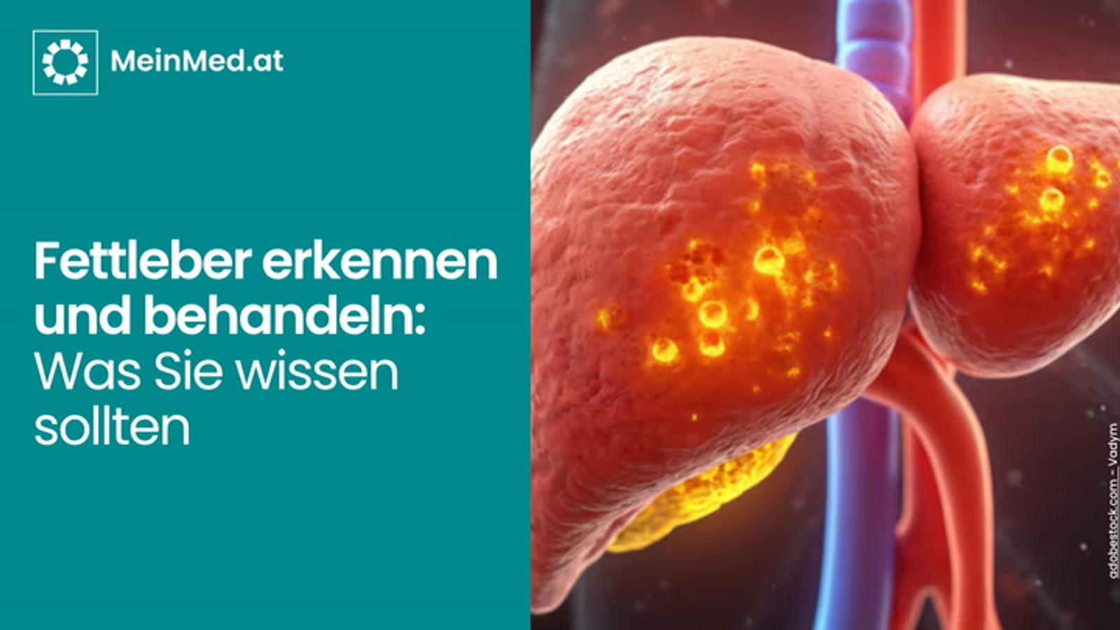 Fettleber erkennen und behandeln: Was Sie wissen sollten